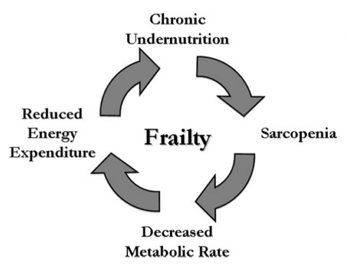 Syndrome of Frailty figure: sarcopenia, malnutrition, and reduced energy expenditure